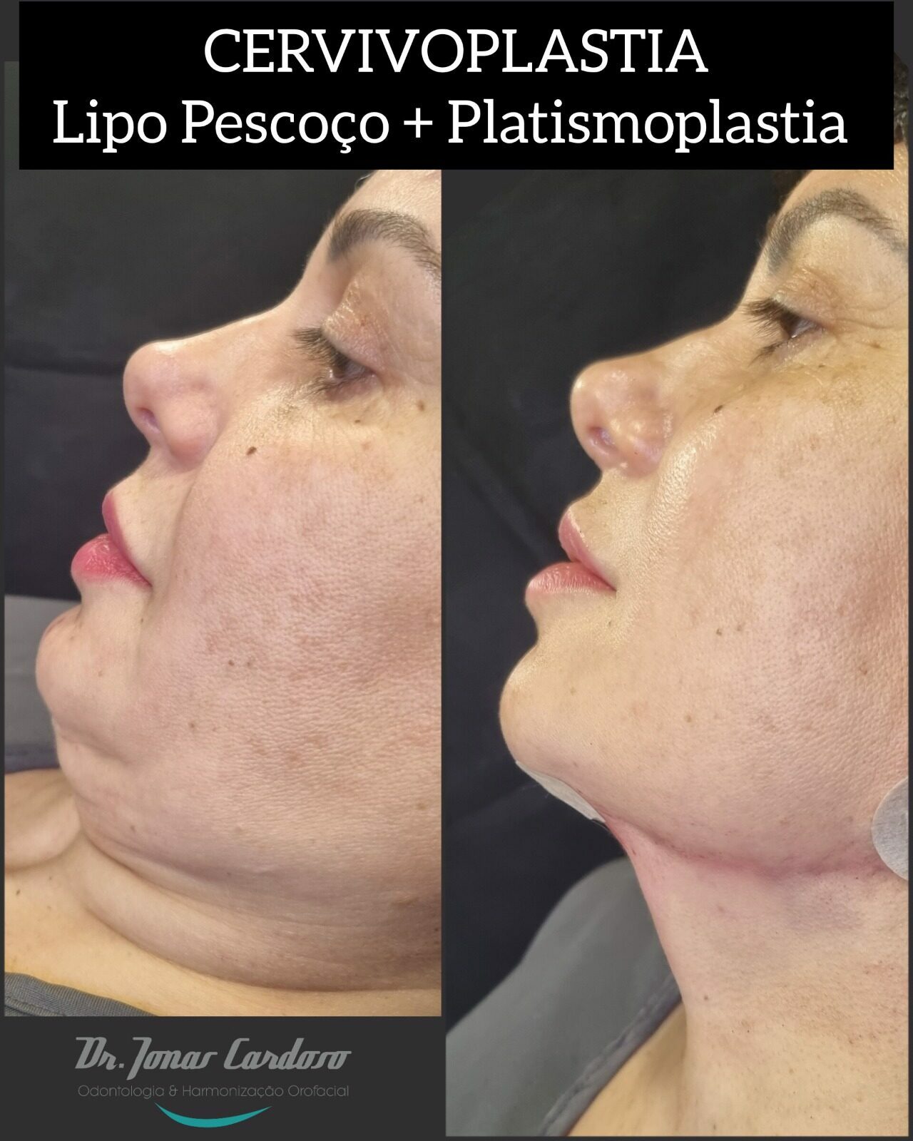 Lipo de Papada HD e Platismoplastia. O que tem de melhor para o contorno do  pescoço. 