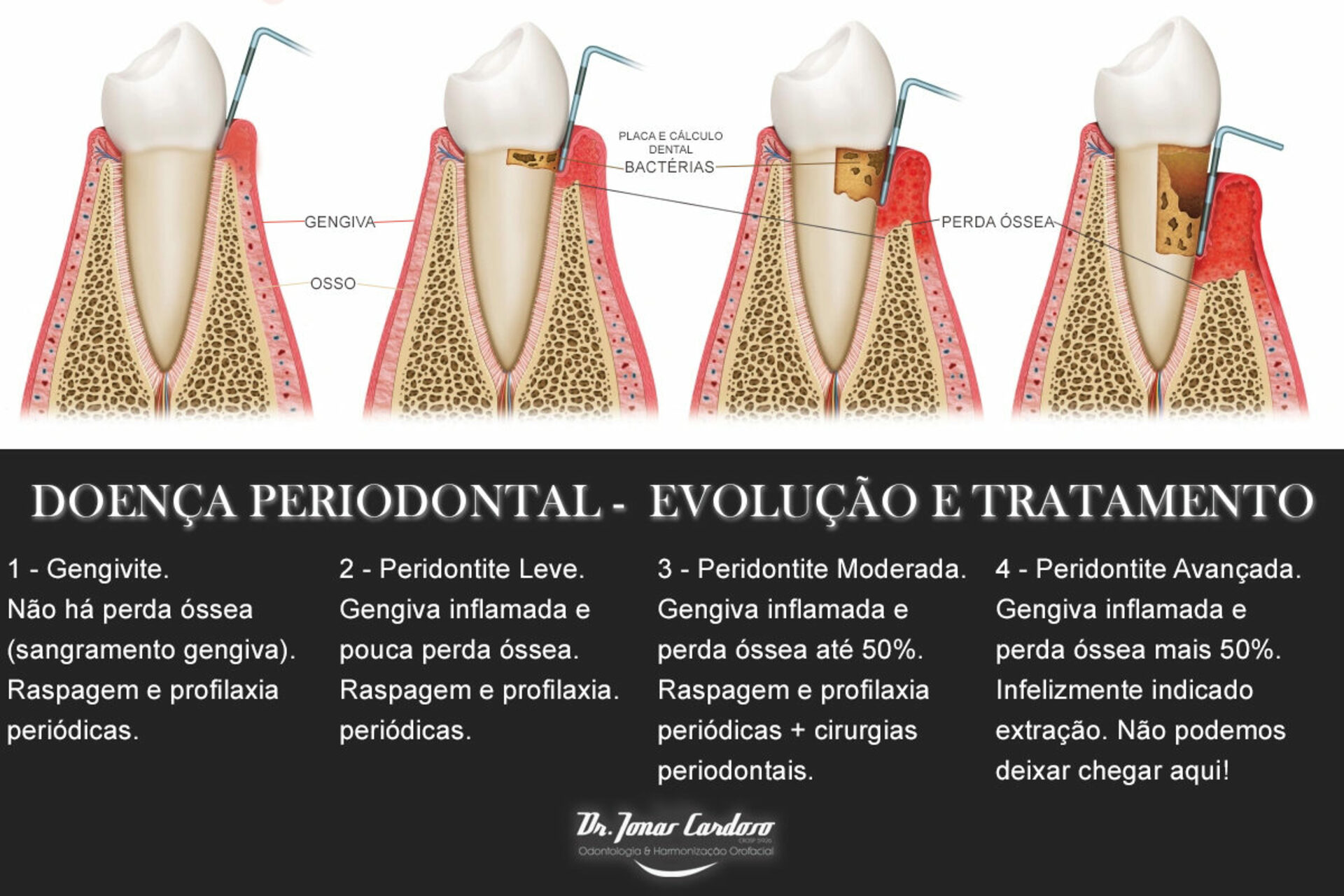 PERIODONTIA Odontolgia De Odontologia Drjonascardosoodontologia Bauru PERIODONTIA Odontolgia De Odontologia Drjonascardosoodontologia Bauru